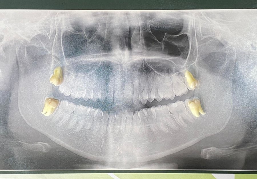 Bucomaxilofacial